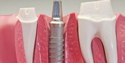 rezultatele unui implant dentar