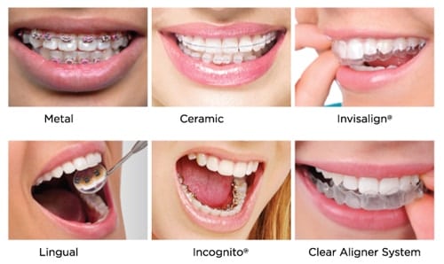 Tratament ortodontic aparat dentar