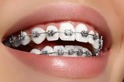 aparate dentare metalice fixe