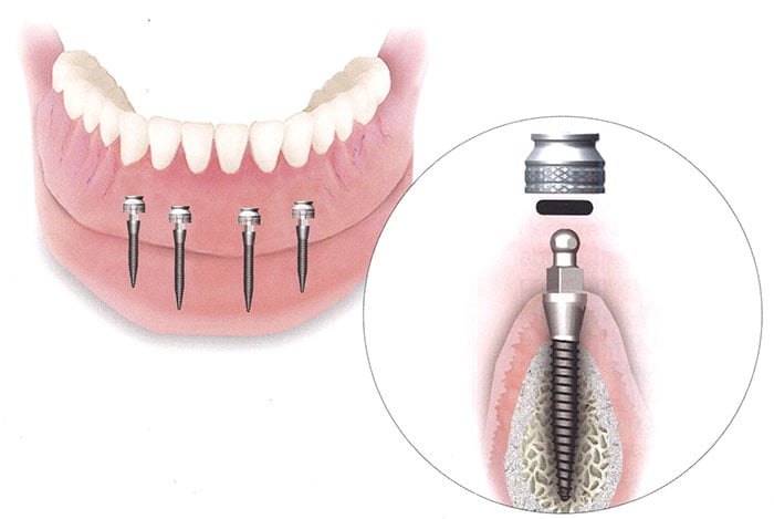 Mini implanturi dentare