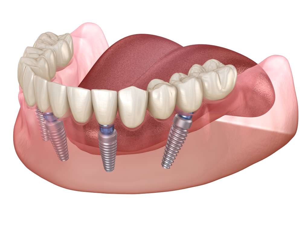 pret implant dentar